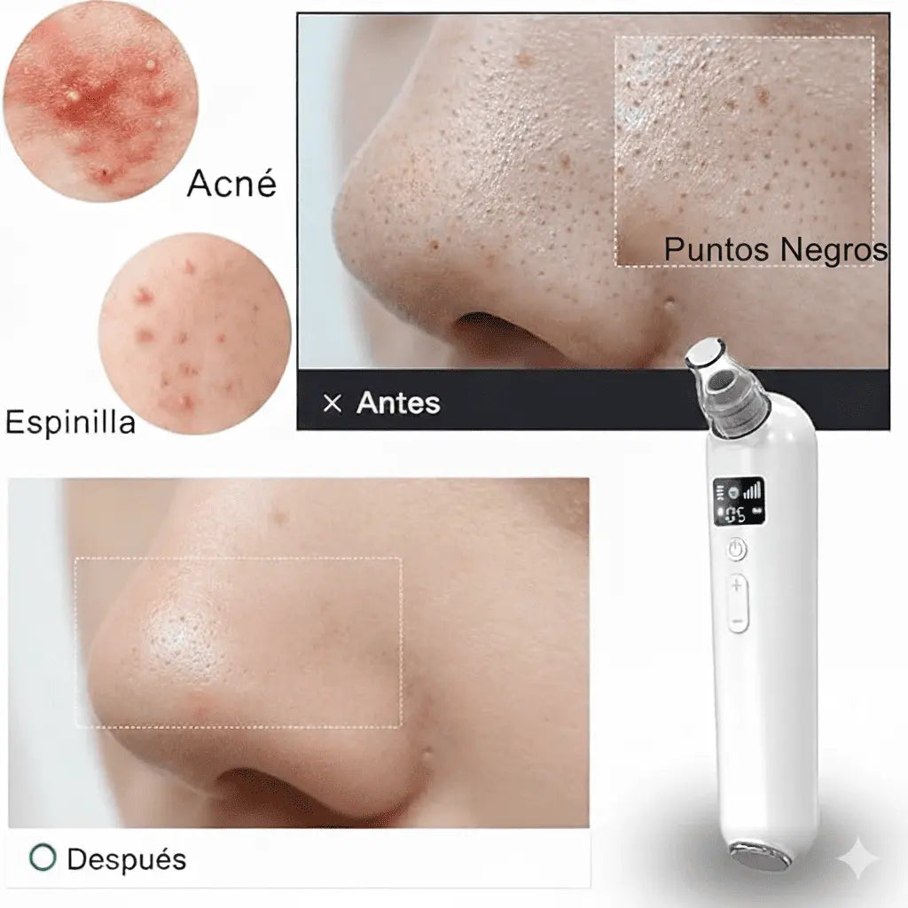 VivaSkin - Extractor de Impuresas